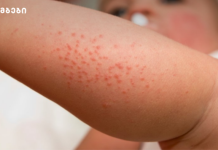 მუნი – რა არის ის, მისი მკურნალობა და პრევენცია