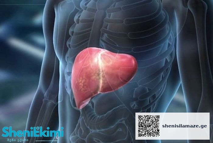 ღვიძლის უკმარისობის პროგნოზი არაკეთი­ლ­სა­იმე­დოა, გამოსავალი ფატალურია, თუ არ ტარდება მკურნალობა ან დაავადება პროგრესი­რებს | შენი სილამაზე