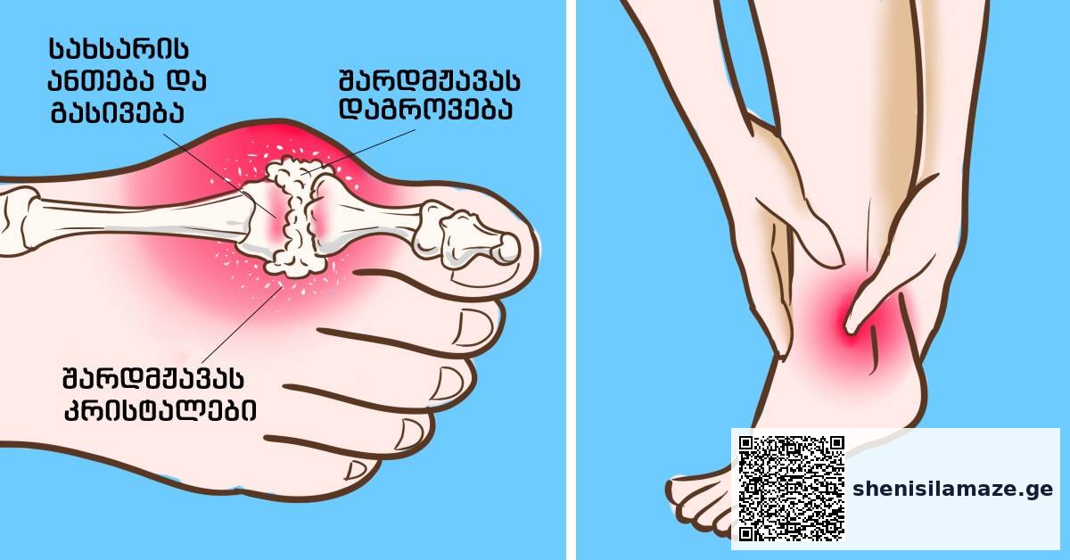 სისხლში შარდმჟავას დონის შემცირება. ართრიტი და პოდაგრა მყისიერად იკურნება, თუ რაციონს დაამატებთ… | შენი სილამაზე