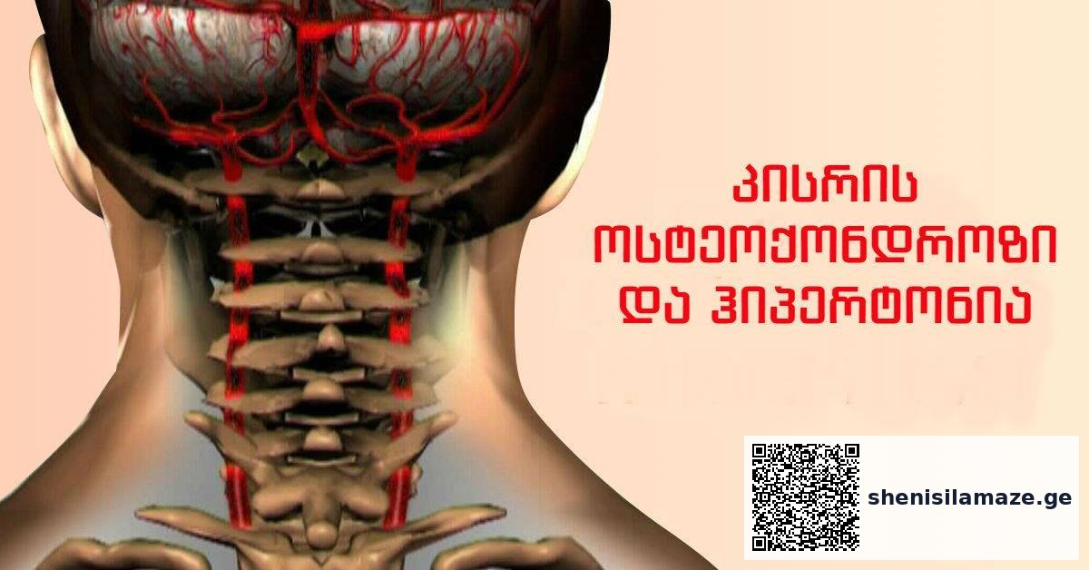მოსახლეობის 90% კისრის ოსტეოქონდროზით იტანჯება. შეაჩერეთ თავის ტკივილი, გულისრევა, თავბრუსხვევა “კისერ-ცერებრალური თერაპიით”! | შენი სილამაზე