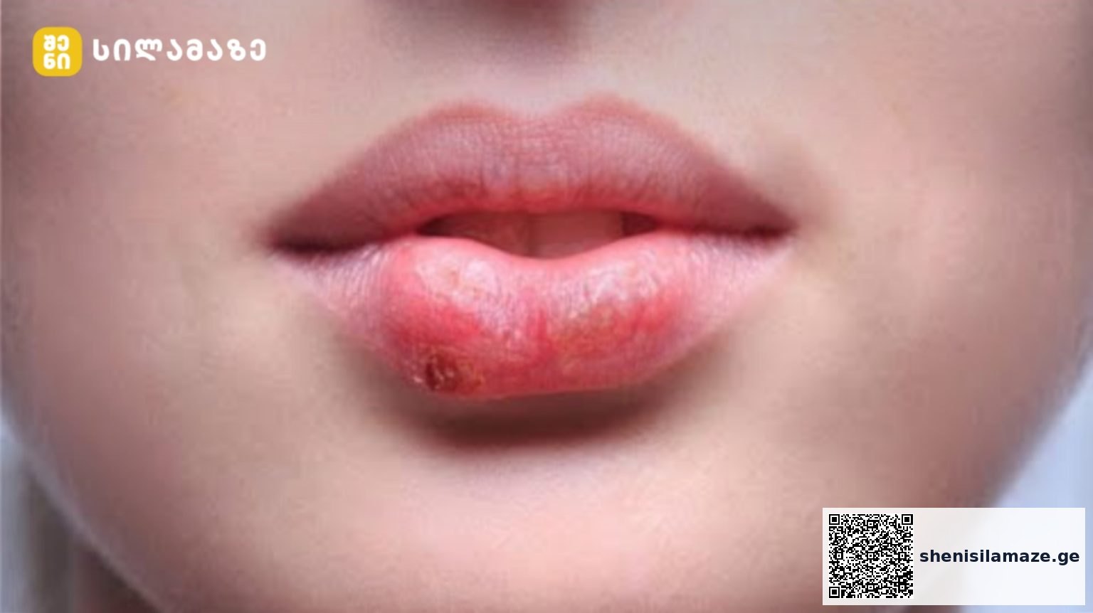 როგორ გავუმკლავდეთ ტუჩის ჰერპესს? როგორ შევნიღბოთ ის? | შენი სილამაზე
